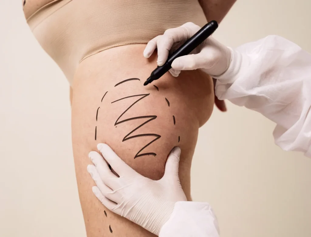 home-1-8-tummy-tuck.webp - Shine Medspa & Microblading Tumescent Liposuction for Permanent Fat Removal in Wakefield, MA