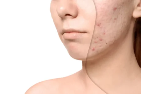 scar-repair-1 - Shine Medspa & Microblading - Shine Medspa & Microblading microblading scar camouflage