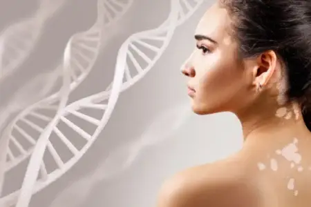 vitiligo - Shine Medspa & Microblading - Shine Medspa & Microblading vitiligo camouflage
