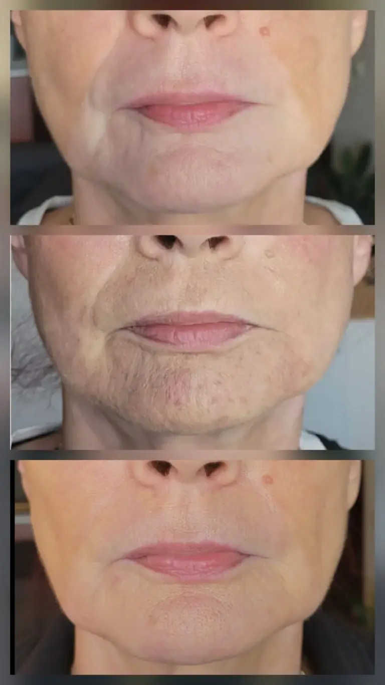 vitiligo treatment
