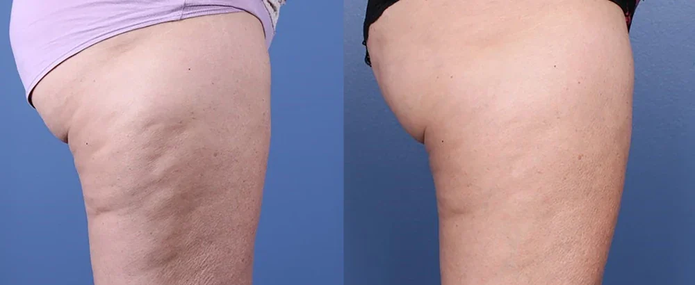 morpheus8 body before and after