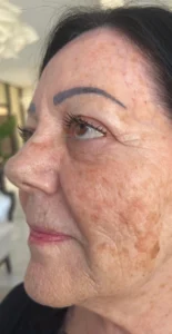 shine-before - Shine Medspa & Microblading - Shine Medspa & Microblading facial before