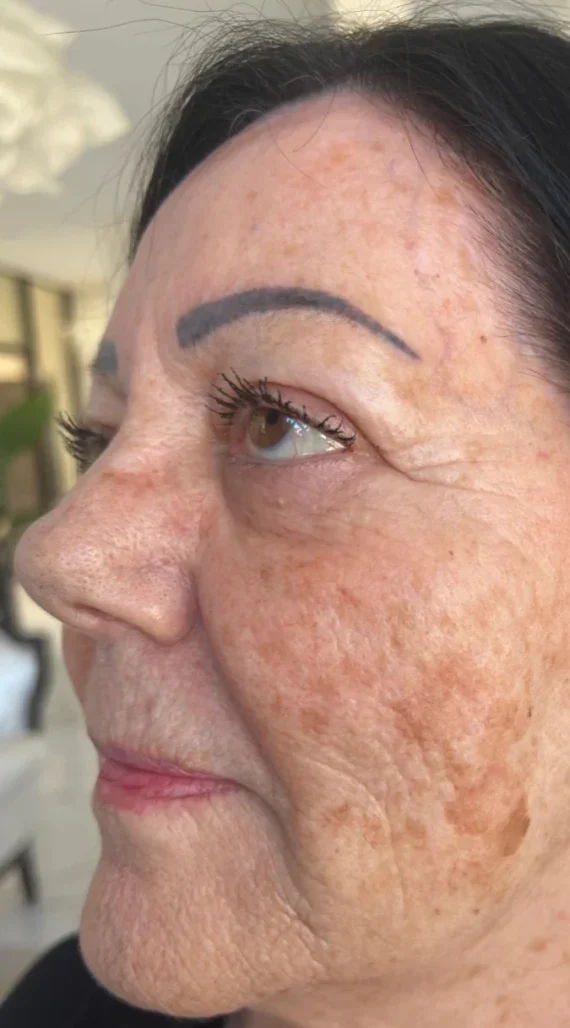 shine-before - Shine Medspa & Microblading - Shine Medspa & Microblading facial before