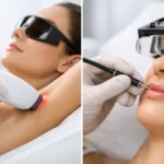 Laser Hair Removal vs Electrolysis